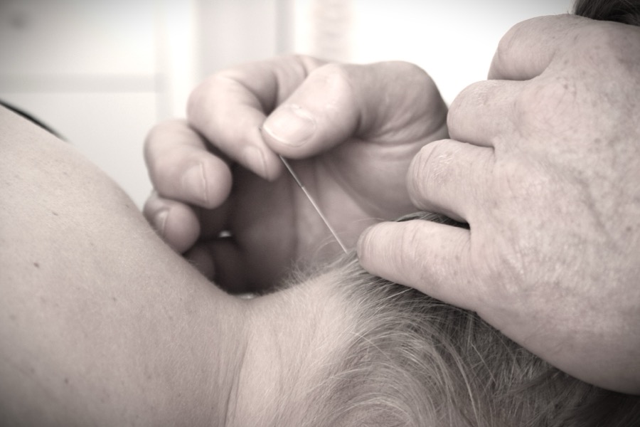 Akupunktur under behandling