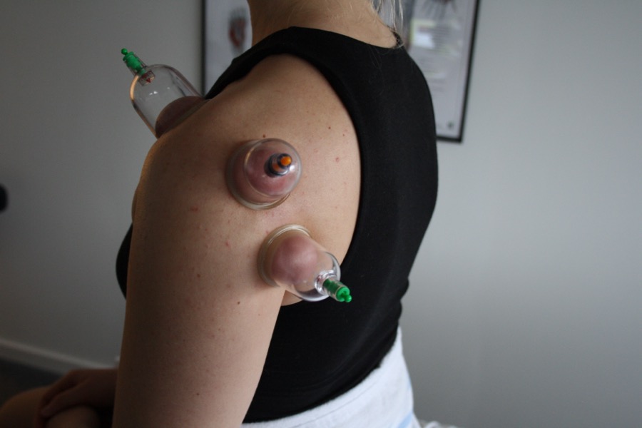 Cupping-behandling af skulder